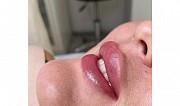 Увеличение губ 